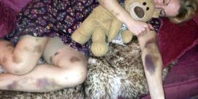 Zgjohet me trupin e mbushur me shenja, muaj më vonë bën zbulimin e frikshëm (Foto)
