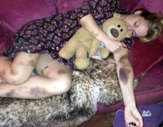 Zgjohet me trupin e mbushur me shenja, muaj më vonë bën zbulimin e frikshëm (Foto)