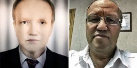 Shndërrohet në zezak pas transplantimit të mëlçisë nga donatori afrikano-amerikan (Foto)