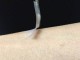 Lajm i mirë për diabetikët: Insulina tash mundet me u marr me elastoplas / fllaster