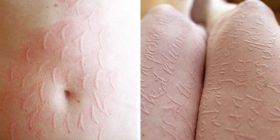 Dermatografia, sëmundja që duket si “alfabet”