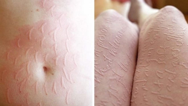 Dermatografia, sëmundja që duket si “alfabet”