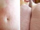 Dermatografia, sëmundja që duket si “alfabet”