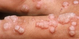 Bëni kujdes nga kjo sëmundje, është më e keqe se HIV’i