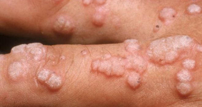 Bëni kujdes nga kjo sëmundje, është më e keqe se HIV’i