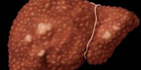 Hepatiti viral vret po aq sa AIDS dhe Tuberkulozi