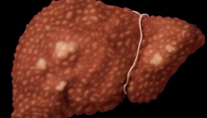 Hepatiti viral vret po aq sa AIDS dhe Tuberkulozi