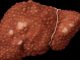 Hepatiti viral vret po aq sa AIDS dhe Tuberkulozi