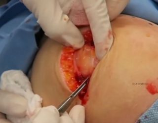 Video, +18: Shihni çfarë cisti i nxjerr mjekja kësaj gruaje