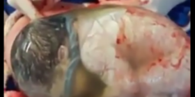 Nëna shpërndan momentin e “lindjes me këmishë” të foshnjës. Video shndërrohet në virale (Video)