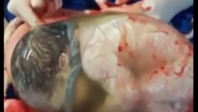 Nëna shpërndan momentin e “lindjes me këmishë” të foshnjës. Video shndërrohet në virale (Video)