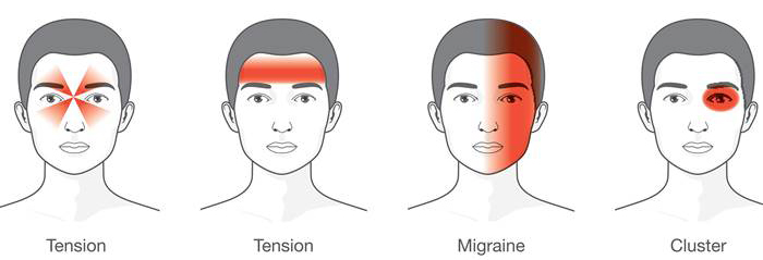 headache-types-today-161109-inline-02_54029d2d360cad513cf6c9f5ba6f484d-today-inline-large